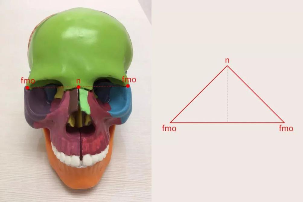 我们通常会使用"鼻颧角"来评估面部是否立体,鼻颧