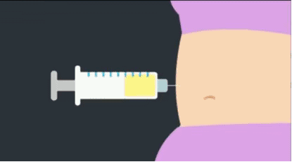 自体脂肪丰胸是用抽脂器从身体脂肪堆积处(如腹部,大腿部 )抽取脂肪