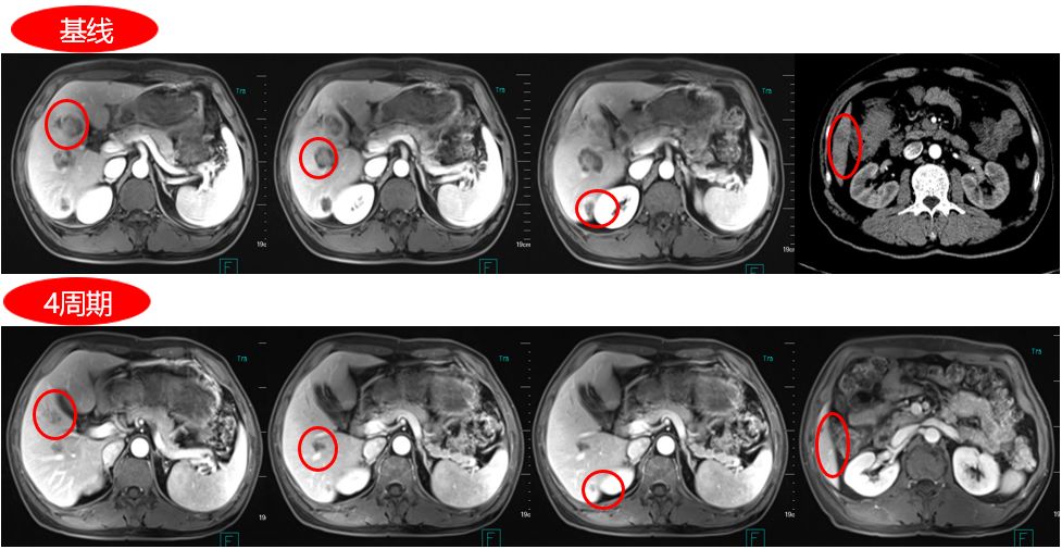 结直肠癌合并肝转移手术否大咖经验倾囊相授