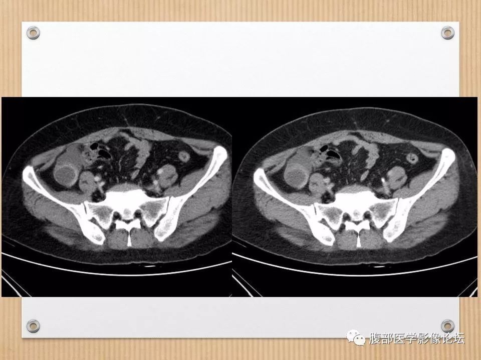 卵巢囊腺瘤ct表现图片图片