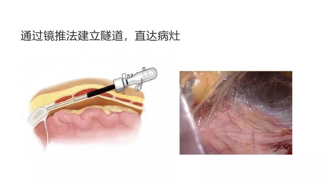 【护理查房】腹腔镜下完全腹膜外腹股沟疝修补术