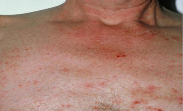 43岁余先生皮肤瘙痒,诊断出肝癌,若皮肤有三个表现可能是癌症