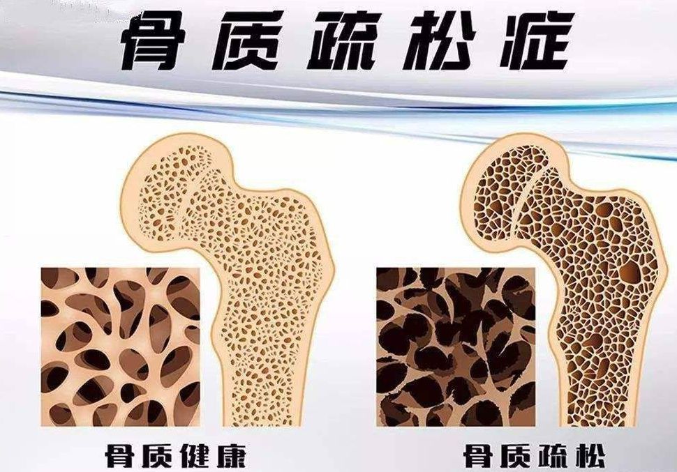 老年人驼背变矮，需警惕骨质疏松，4个方法，帮你强健骨骼-搜狐大视野-搜狐新闻