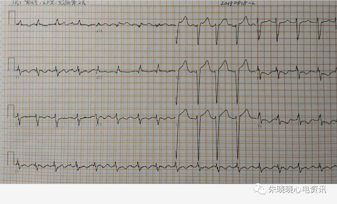 前降支病变心电图特征图片