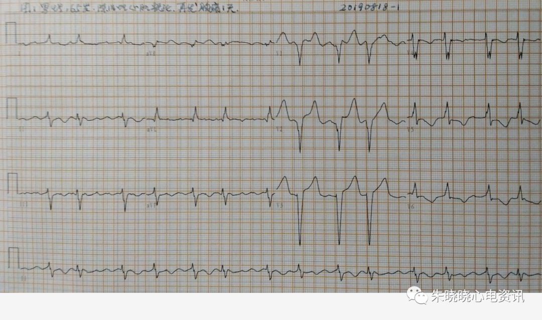 前降支病变心电图特征图片