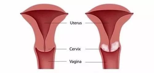 阻隔了外界和阴道的病原体进入子宫,所以,宫颈是女性炎症防御的第一站