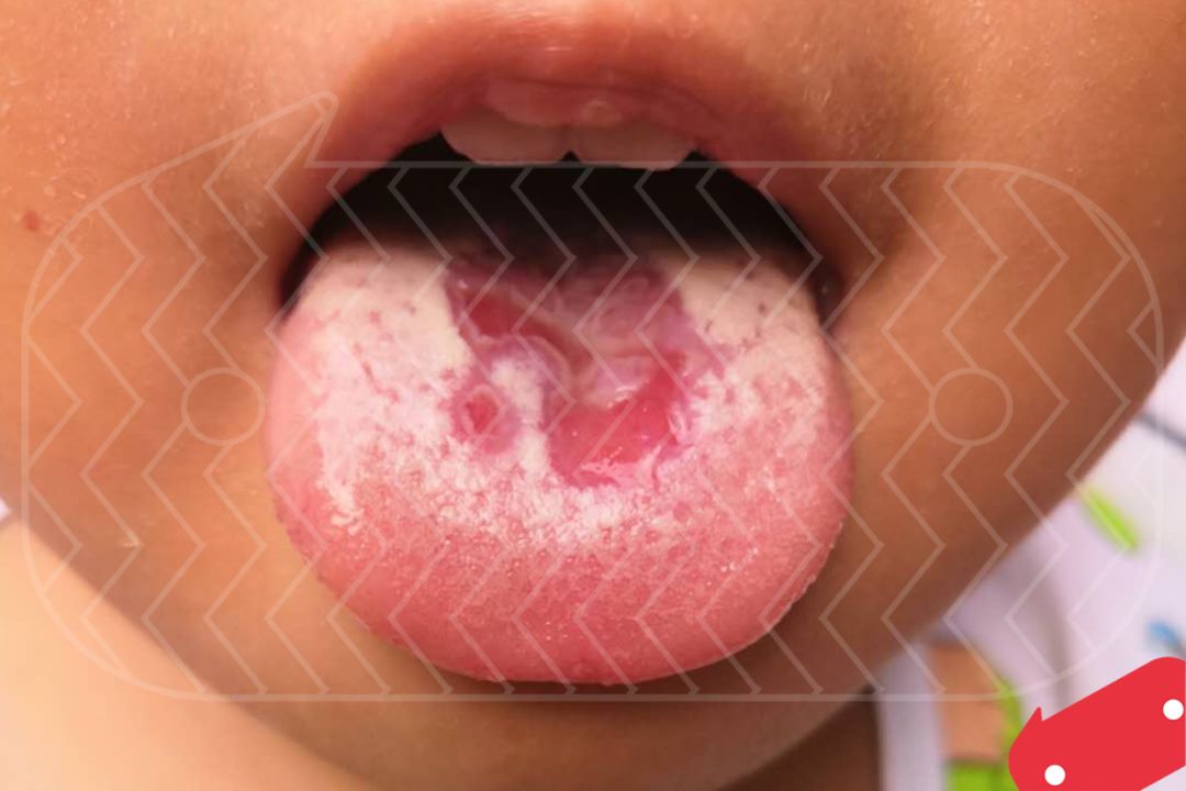 孩子舌头溃疡图片图片