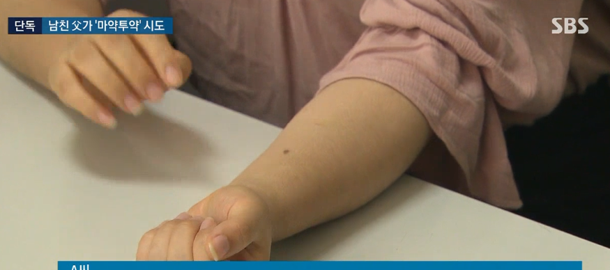 女事主展示针眼痕迹(sbs新闻)看到女事主报警后,准公公立即驾车落荒而