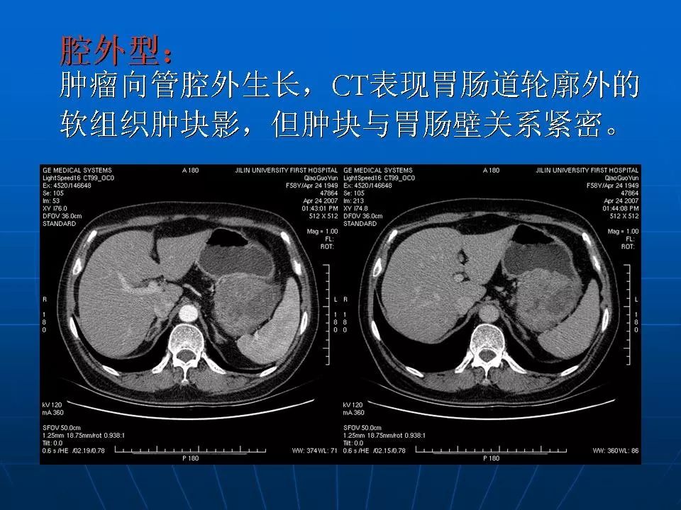 胃肠道间质瘤的ct诊断丨影像天地