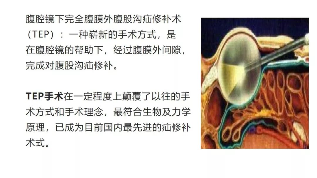 【护理查房】腹腔镜下完全腹膜外腹股沟疝修补术_手术室