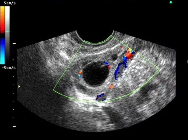 阴氏彩超图片