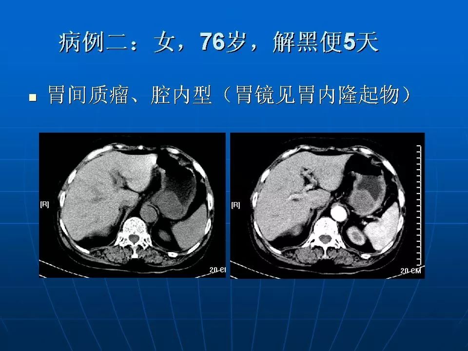 胃肠道间质瘤的ct诊断丨影像天地