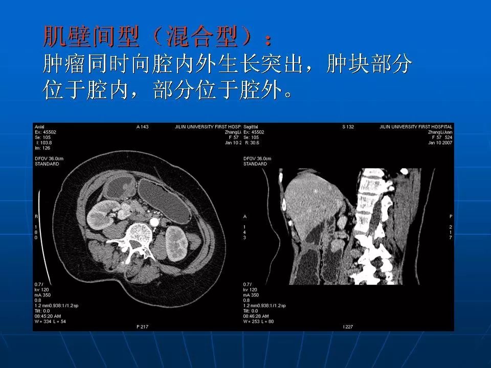 胃肠道间质瘤的ct诊断丨影像天地