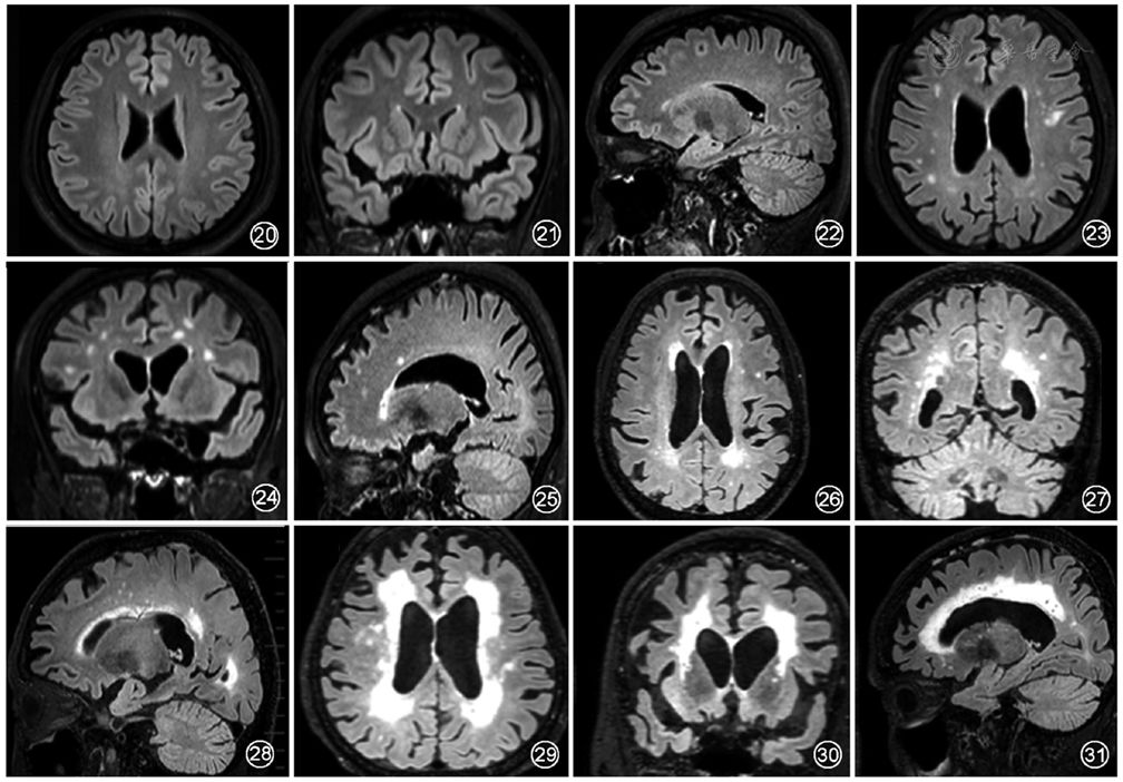 早期ad所致的腦白質病變主要為額葉,顳葉等白質纖維及胼胝體壓部的