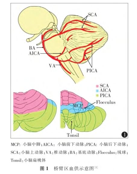 桥臂即小脑中脚,由脑桥基底部对侧脑桥核发出的脑桥小脑纤维构成,是