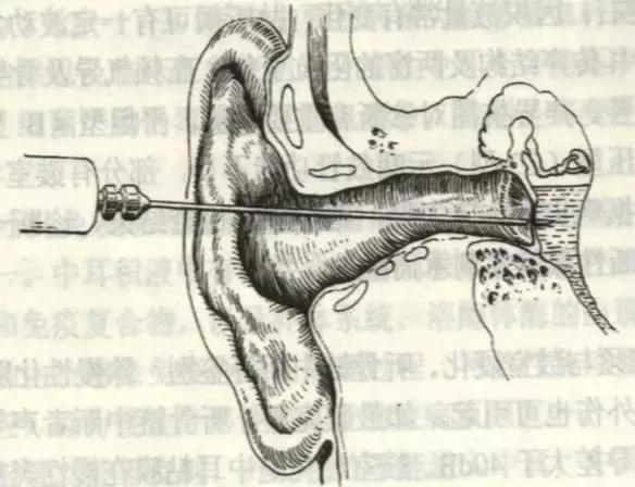 耳朵积液穿刺手术图解图片