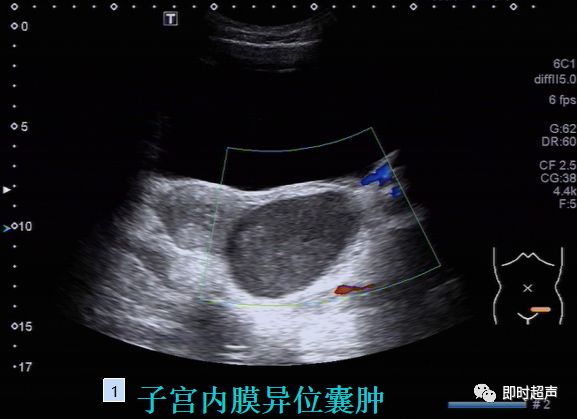 內部不完全分隔消失,餘節段和卵巢均可被擠壓大家來說說:它們是什麼?