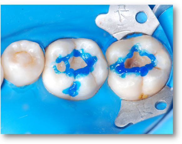 声动树脂印章法后牙充填一例