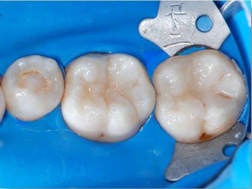 声动树脂印章法后牙充填一例