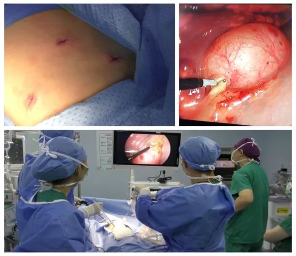 媒体聚焦信息时报做纵隔肿瘤切除术11岁小患者仅用6小时完成出入院