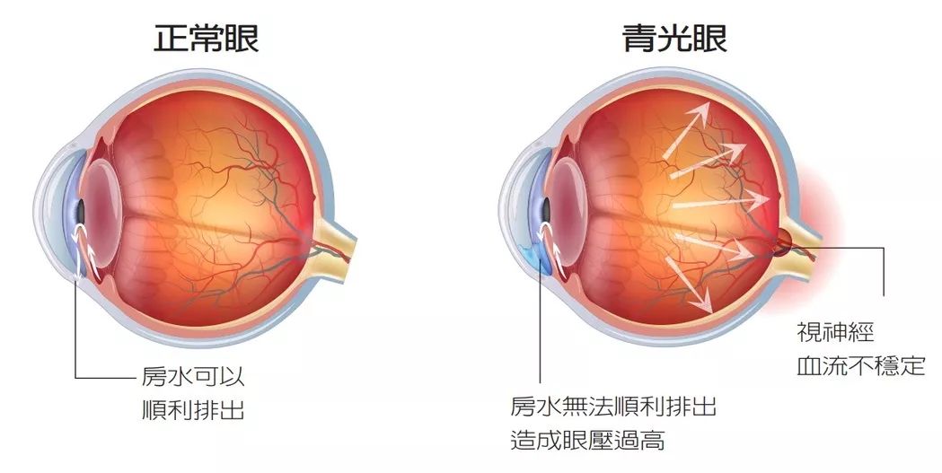 巩膜炎有什么症状