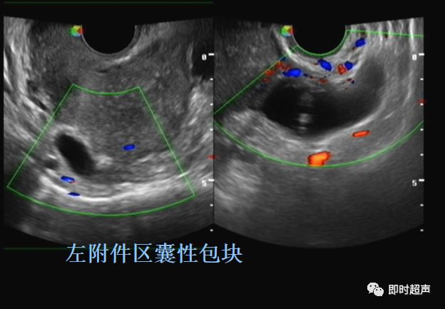 一侧或两侧输卵管行走区卵巢旁探及长管状或腊肠型的囊性包块,囊壁