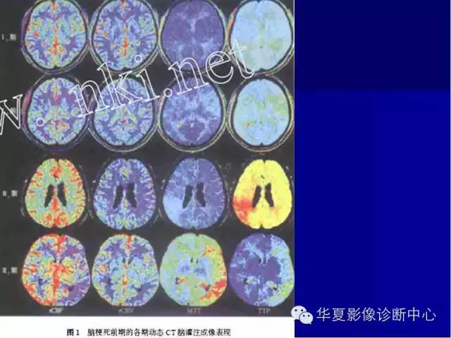 一文搞懂ct脑灌注成像