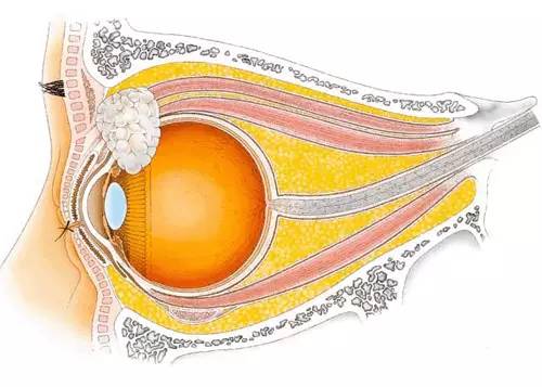 眼科解剖圖 眼眶骨眼科圖譜虹膜與睫狀體眼球橫切面示意眼球摘除術