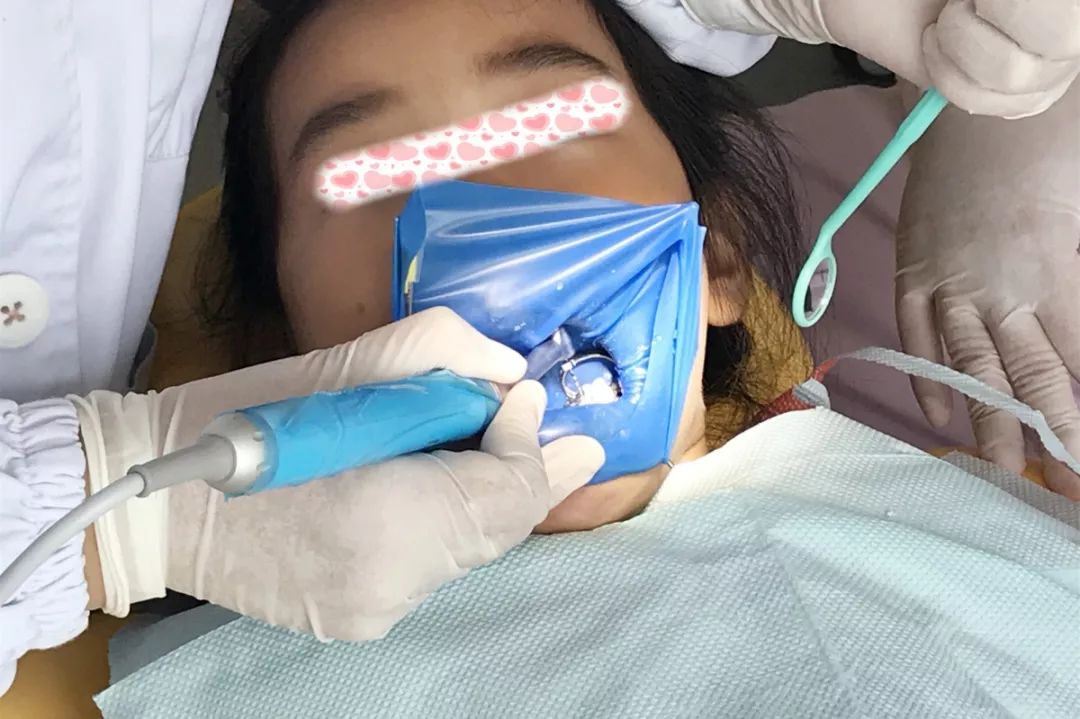 惊五龄童看牙误吞针牙医后悔未使用橡皮障隔离术