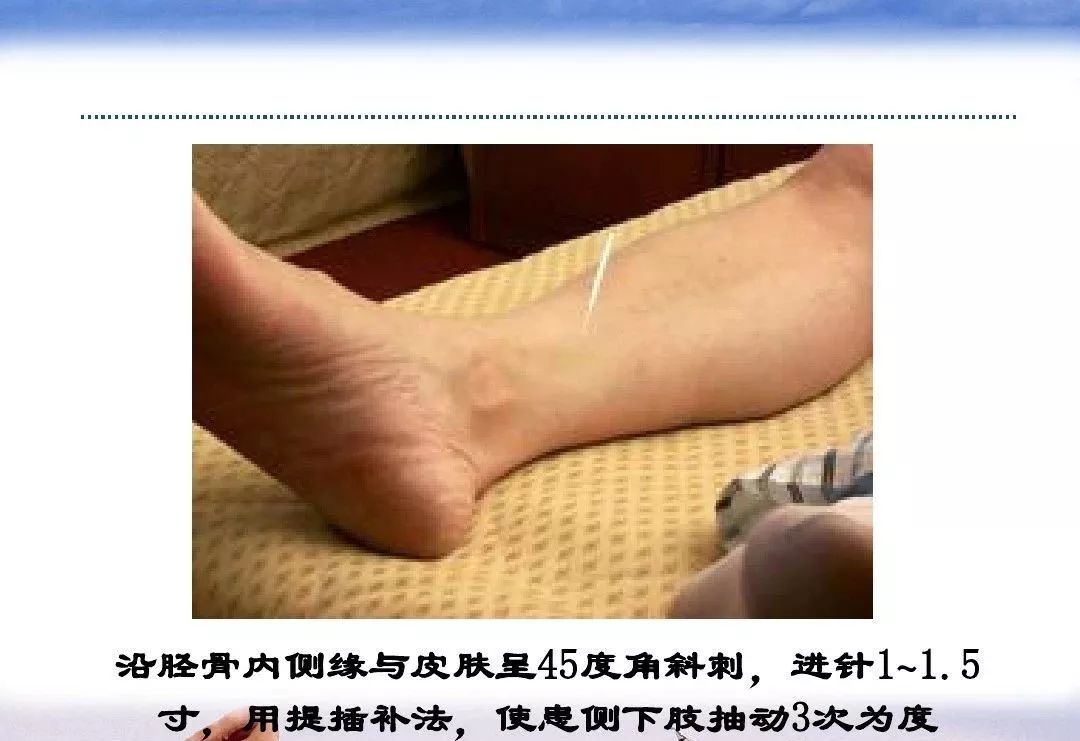 针灸治疗中风临床讲解