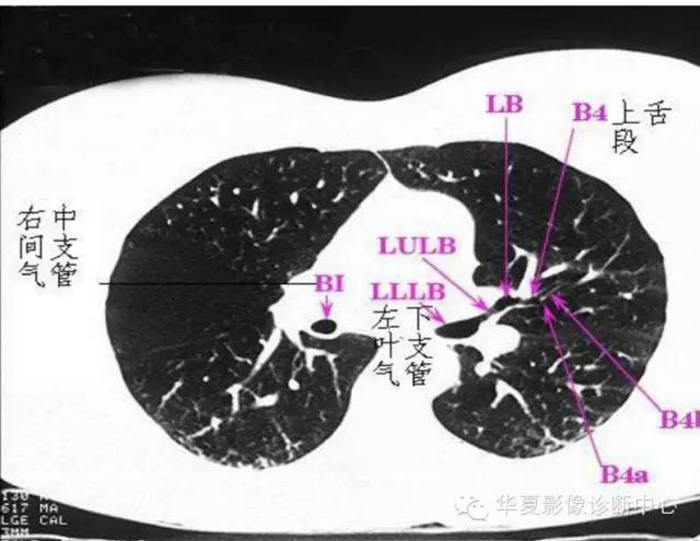 肺部分段ct断面解剖图图片