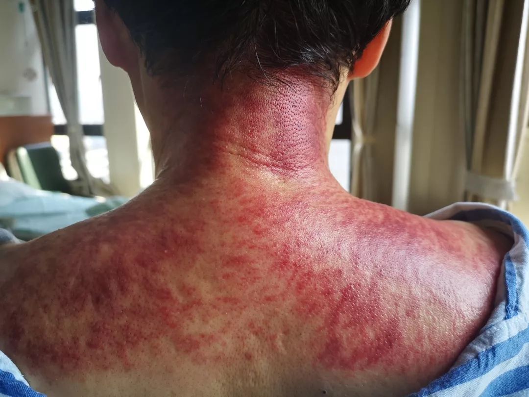 健教走进铜砭刮痧
