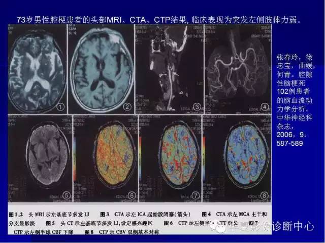 ct灌注成像图像解读图片