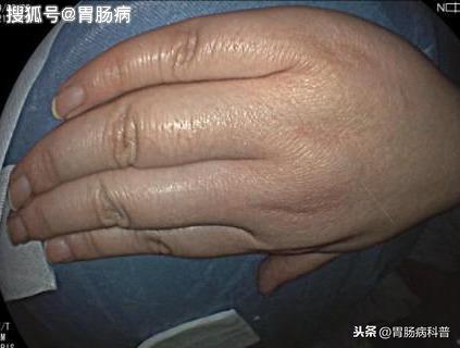 29岁小伙怕做胃镜,做钡餐——把胃癌当"胃溃疡"治了半年多.