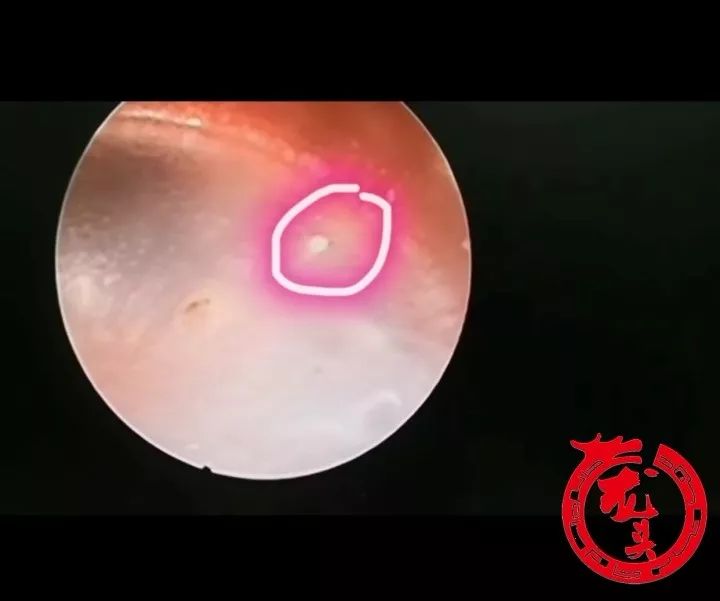 哈尔滨女孩耳朵里老沙沙响一查吓坏了好几个洞家中咪咪是祸首