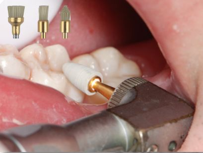 声动树脂 印章法:后牙充填一例