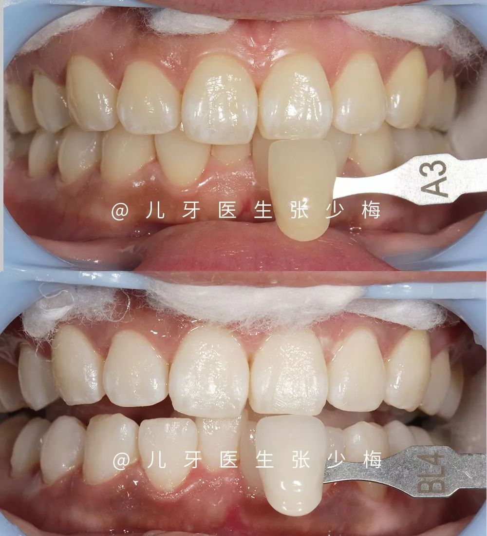 牙齿真的越白越好吗