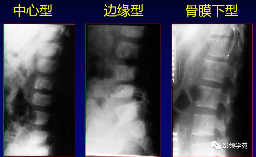 骨结核x线表现图片