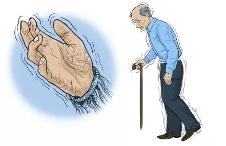 患者出现手抖,肢体僵硬,动作慢等症状,导致运动障碍,认知障碍,痴呆等