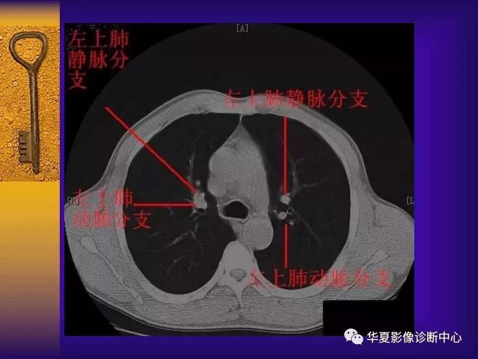 上腔静脉ct断层解剖图图片