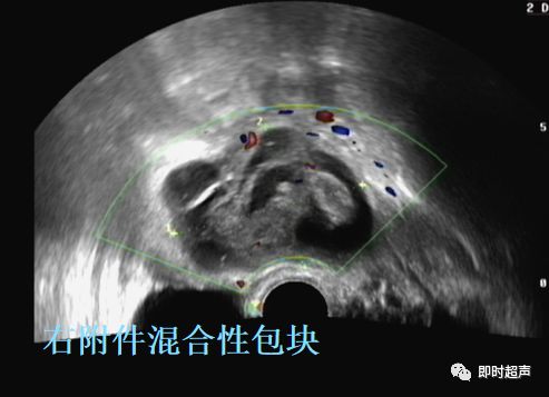 表現:一側或兩側輸卵管行走區卵巢旁探及長管狀或臘腸型的囊性包塊,囊