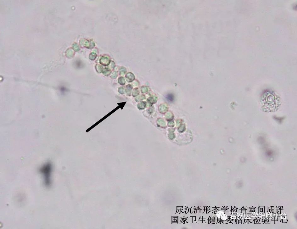 点击空白处查看答案白细胞管型2019514请报告箭头所指图象的名称(未