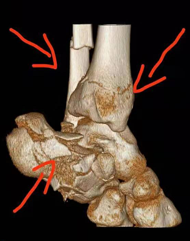 14岁女孩五楼摔下多处骨折并截瘫,广州医生4次手术助她站起来