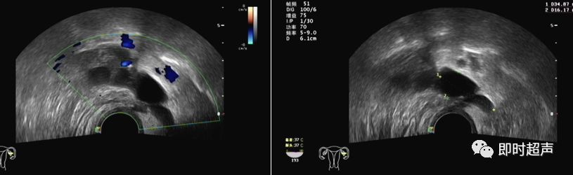 卵巢積液,又有卵泡的存在,子宮旁的 包塊常呈多房狀,常有