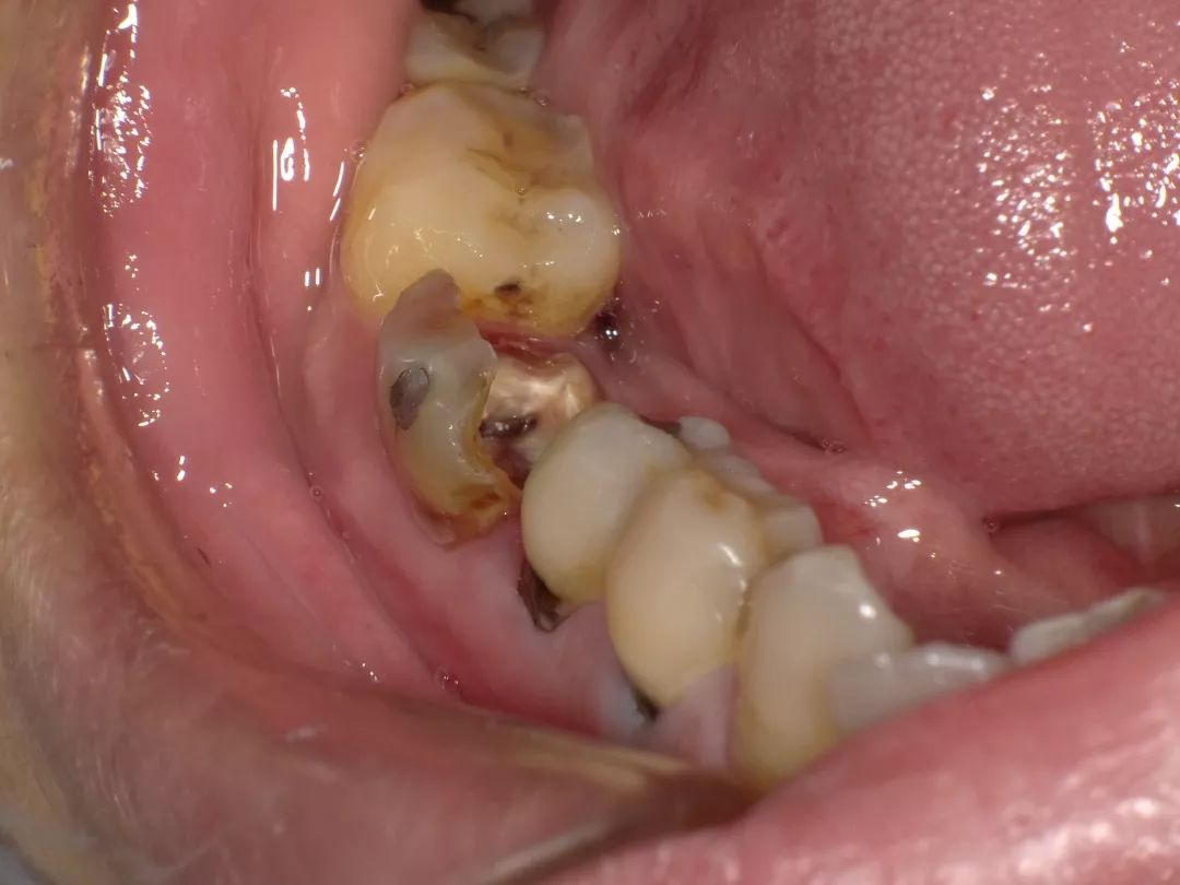46牙舌侧及远中牙体缺损,缺损近龈缘,余留部分汞充材料,探及穿髓孔,冷