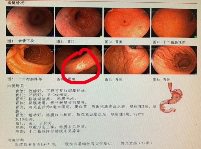 胃镜发现胃角有一个8毫米的溃疡,做了病理化验,证实是高分化腺癌