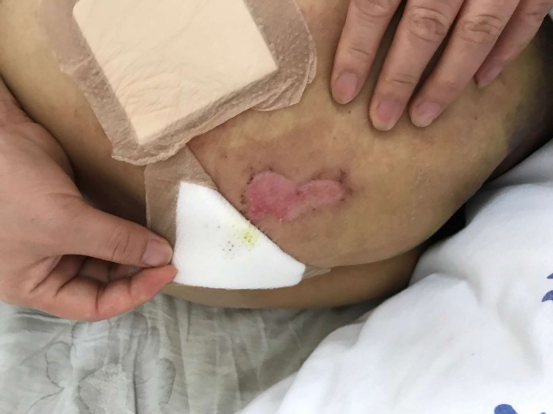 护士长,别罚款,这个水泡不是我的错!