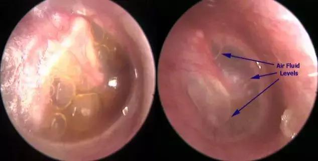 耳朵鼓室积液图片