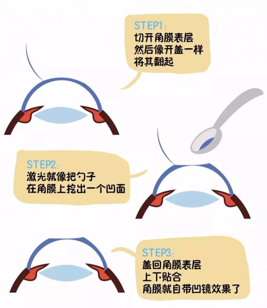 还有比更神奇的就是飞秒手术飞秒手术的原理和激光差不多但操作更炫酷