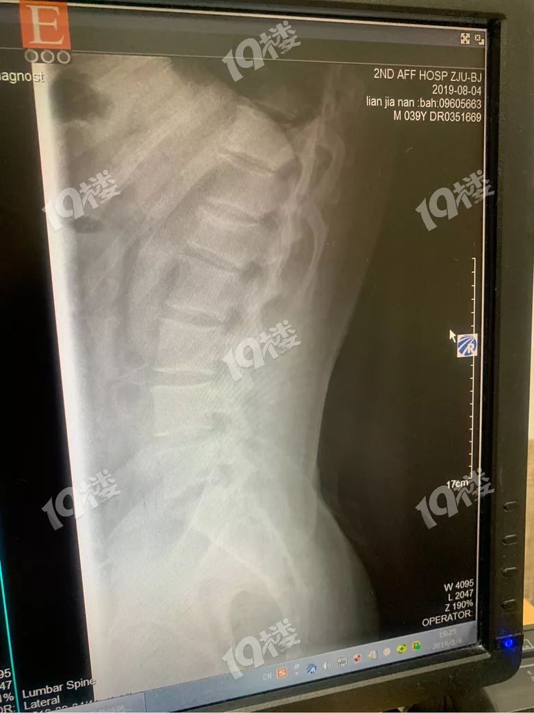 警惕玩网红海绵池爸爸摔成腰椎骨折玩耍也不可大意